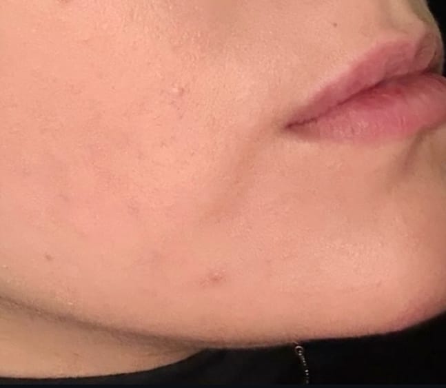 The same cheek after treatment, with the raised lesions resolved and redness reduced