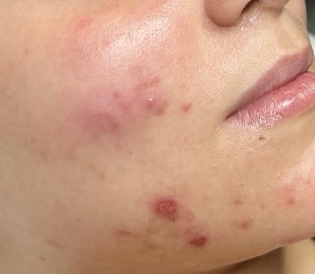 A client’s cheek before an acne facial, showing raised, inflamed breakouts