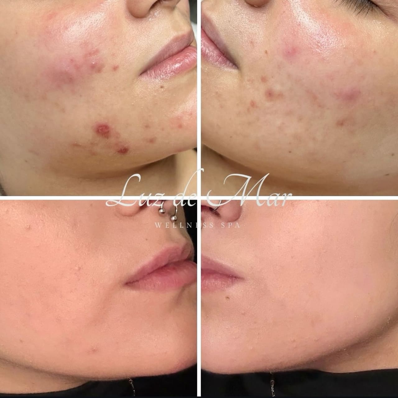 Before and after comparison showing reduced acne and inflammation following a course of acne facials