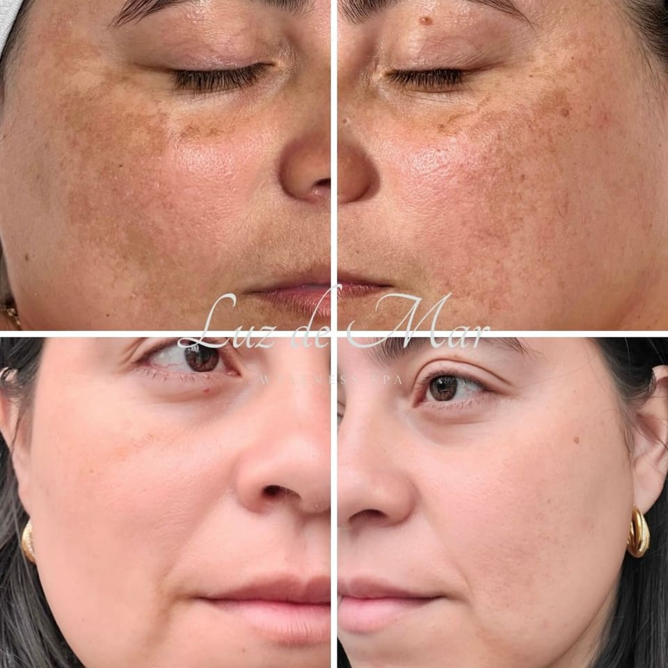 Four-panel before and after of a client’s cheeks: dark patches of pigmentation in the top row, visibly lighter and more even in the bottom row