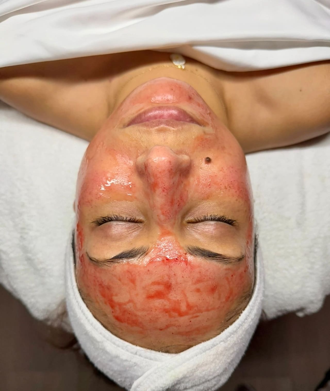 A client lying face-up with a red-tinted serum across the face during a micro-needling treatment