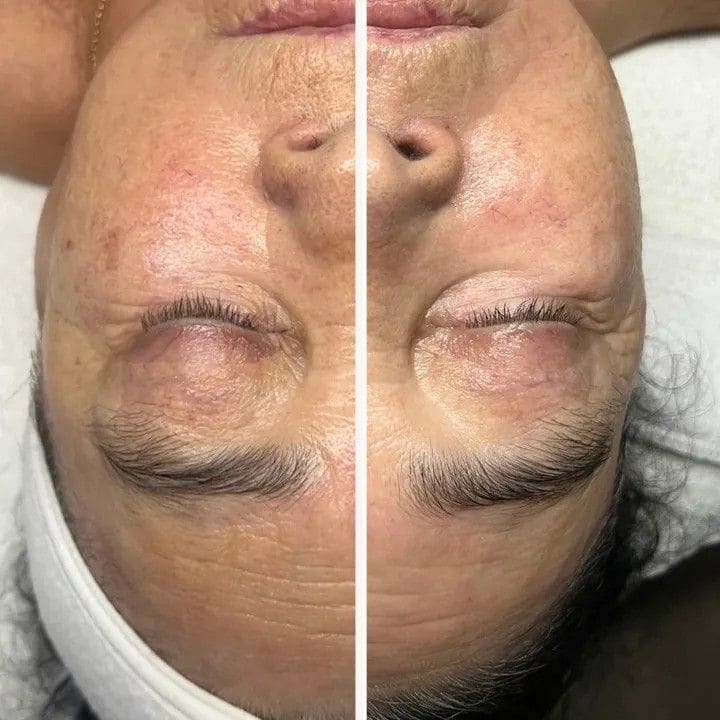 Side-by-side before and after of a client’s face, photographed from above, for the Protein Face Lift Facial