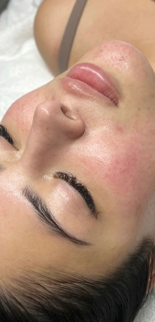 The same face after treatment, with the redness noticeably calmer and more even