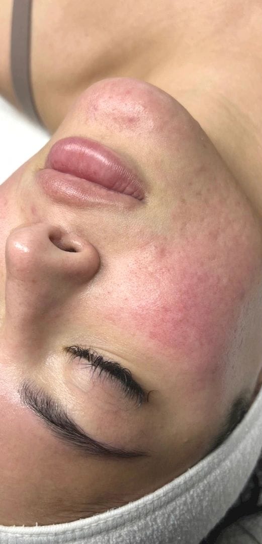 A client’s face before a rosacea facial, showing pronounced redness across the cheek