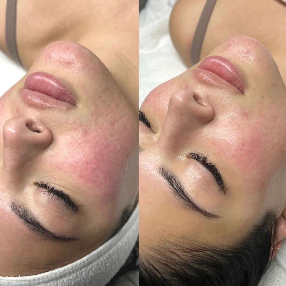 Before and after comparison showing calmer skin and reduced redness across the cheeks